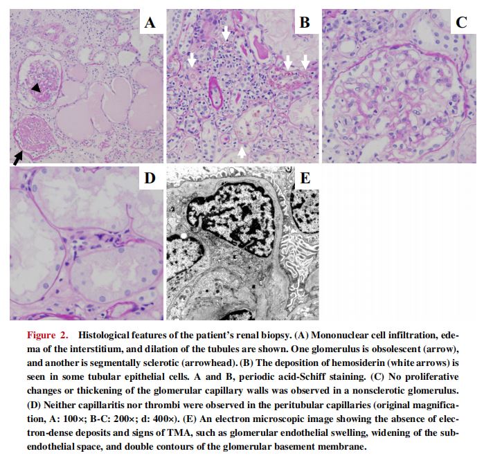 Histological features of the patient's renal biopsy. (A) Mononuclear cell infiltration, edema of the interstitium, and dilation of the tubules are shown. One glomerulus is obsolescent (arrow),  and another is segmentally sclerotic (arrowhead).